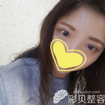 我找成都纽莱茵韩国郑在祐做双眼皮失败修复第20天恢复效果图