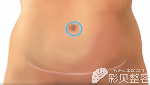 乳房自体重建肚子上留疤大吗