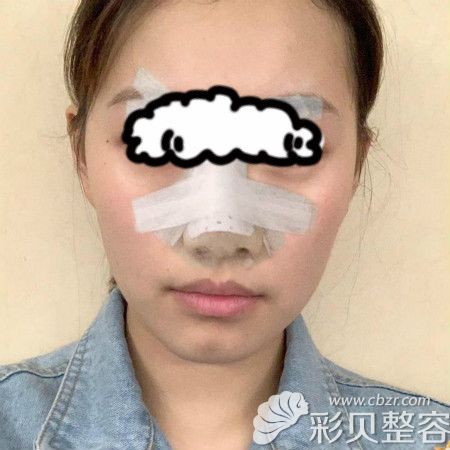深圳润泽瑞尼丝刘庚给我做肋骨鼻子术后第3天效果