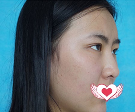南京鼻祖朴光哲耳软骨隆鼻案例曝光,术后效果惊到了很多人
