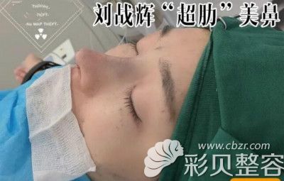 洛阳莱尔美刘战辉给我做舒铂超肋鼻术后即刻效果图片