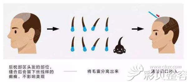 赵进医生科普：植发对人有什么危害吗