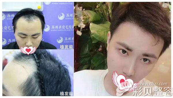 苏州圣爱医院发际线种植案例图