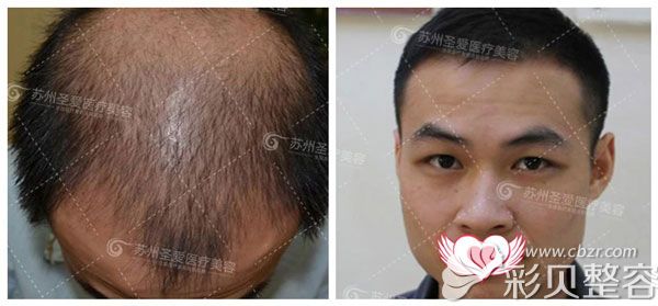 圣爱毛发医院头顶稀疏加密植发案例