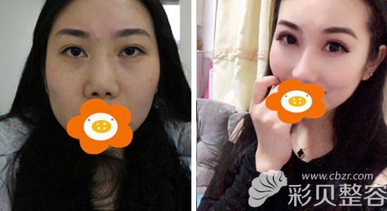 文科医生做肋骨鼻前后对比照