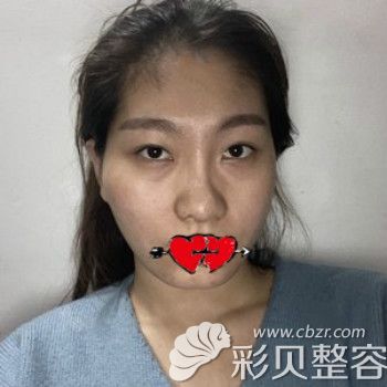 我在杭州美天美医疗美容做面部埋线提升前照片
