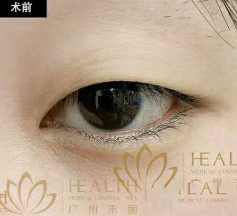 广州禾丽眼综合案例:肿泡眼的我做了小平行7mm双眼皮后,绝了