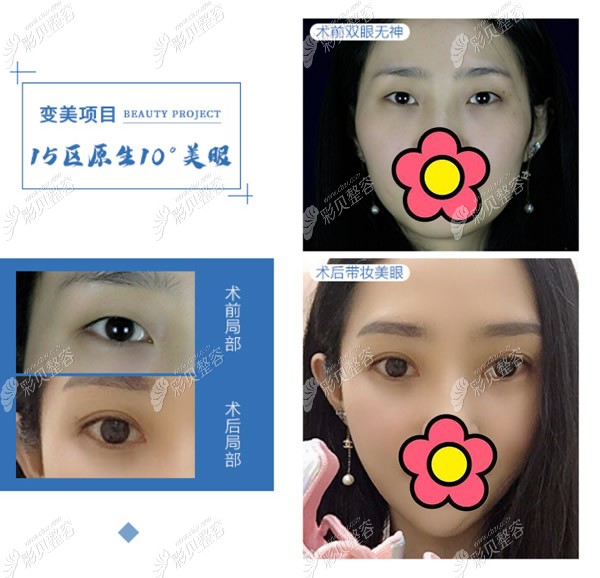 四川友谊医院李萍做双眼皮,两个月后真的没有肉条和疤痕呢!