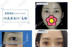 四川友谊医院李萍做双眼皮,两个月后真的没有肉条和疤痕呢!