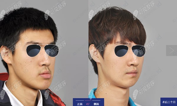 韩国ID医院双鄂手术<span style=