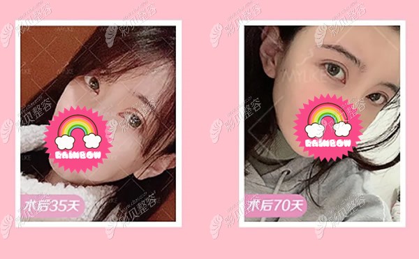 北京美莱杜园园双眼皮修复案例