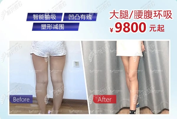 广州韩妃吸脂瘦大腿价格和效果