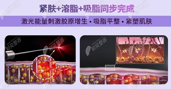 5G天使光雕集吸脂溶脂紧肤于一体