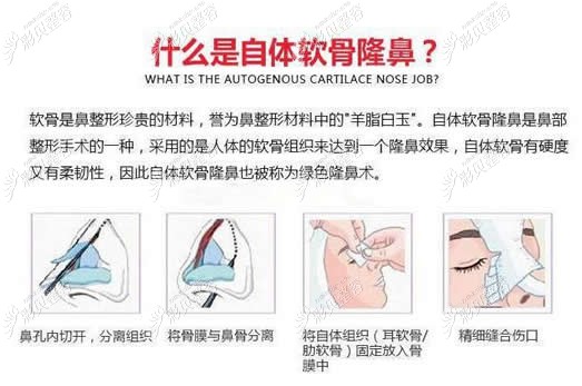 南京美贝尔医院肋软骨隆鼻价格比耳软骨贵多少钱?贵在哪里?