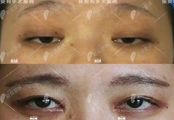 张安利重度上睑下垂修复案例图
