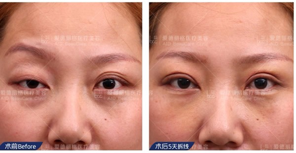 爱德丽格做的双眼皮不行?这种谣言千万别信,信了肯定会后悔