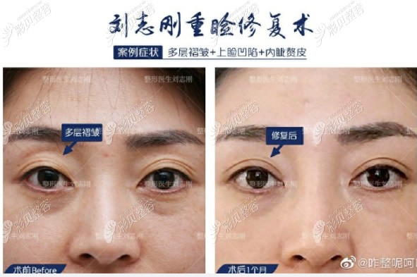 爱德丽格刘志刚三眼皮修复案例