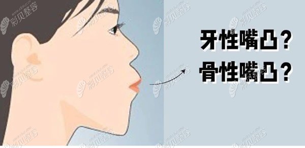 牙性嘴凸和骨性凸嘴的区别
