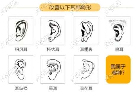 招风耳、杯状耳、隐耳、耳缺损等都属于畸形耳