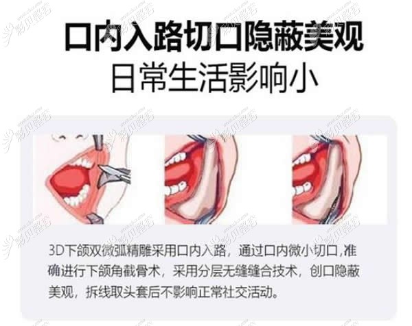 下颌角磨骨手术做口内入路的优势