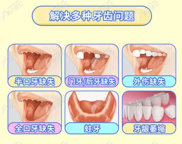 种植牙能解决的牙齿问题