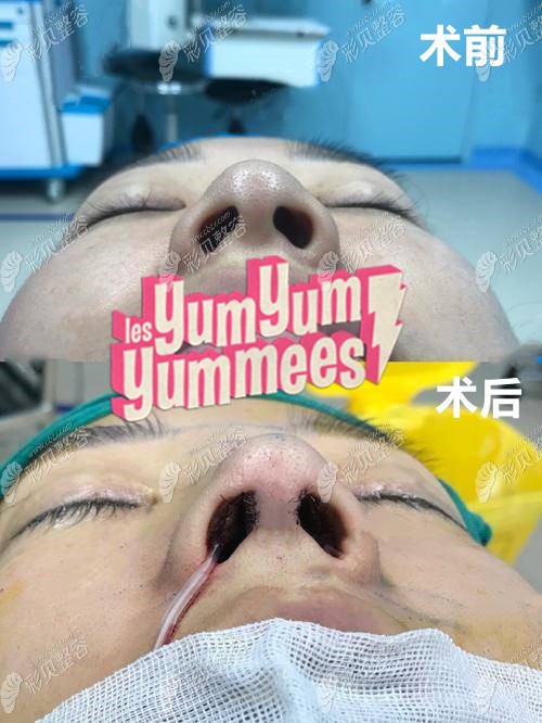 武汉艺星医疗美容杨斐医生做鼻子即刻效果照片对比