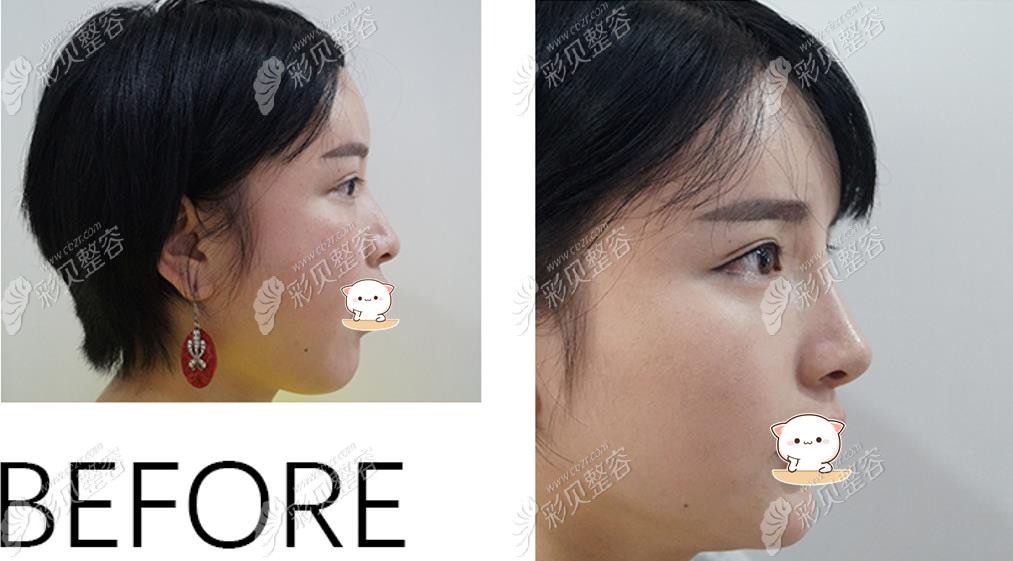 南京鼻祖隆鼻效果图 南京鼻祖隆鼻效果图