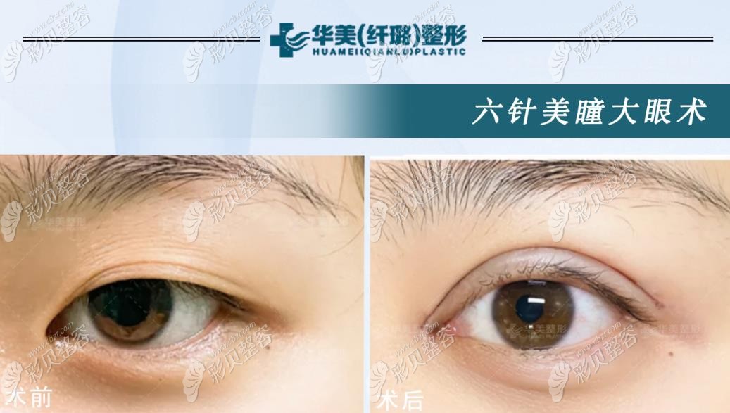 怀化华美纤璐整形眼综合术前后对比照