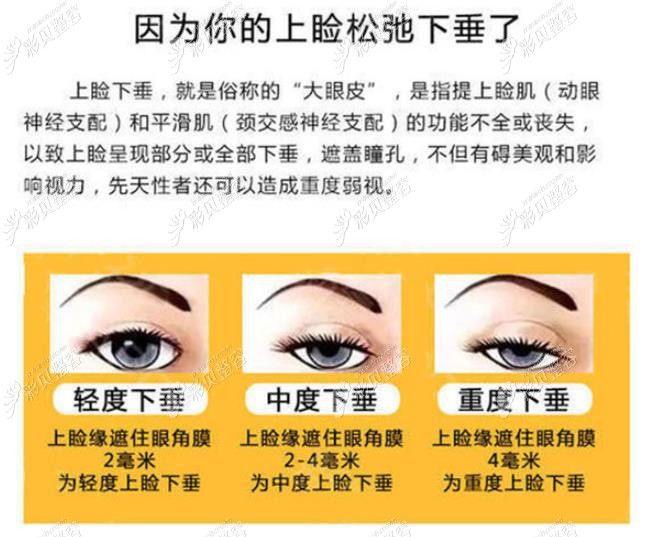 上睑下垂是什么