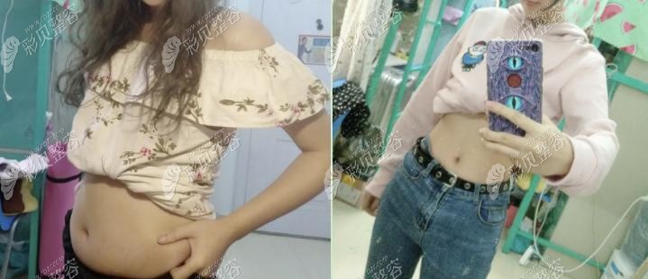 成都军大水动力腰腹环吸前后对比照片