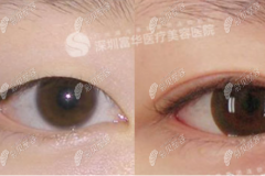 深圳富华做双眼皮怎么样，打听到眼综合价格能接受技术也OK
