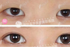 深圳富华做双眼皮怎么样，打听到眼综合价格能接受技术也OK