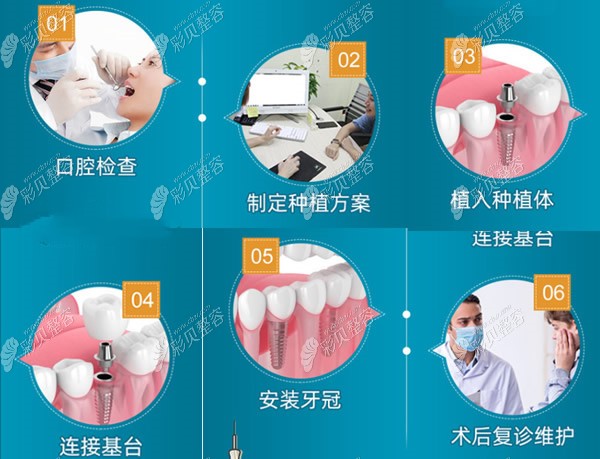 广州中家医口腔种植牙过程和步骤