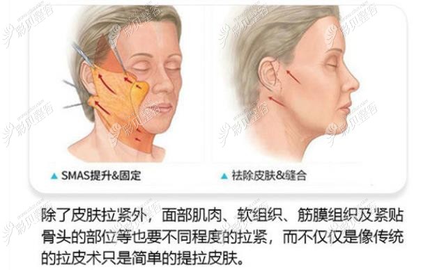 南京施尔美拉皮手术技术优势