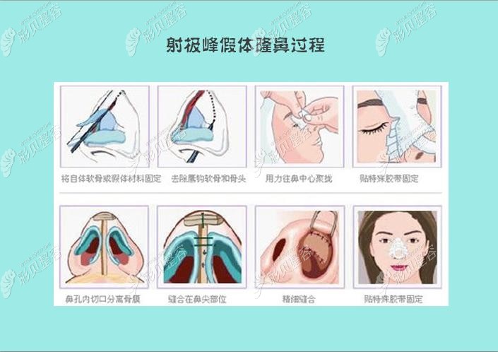 射极峰假体隆鼻的过程 射极峰假体隆鼻的过程