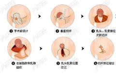 分享广州做缩胸手术正规的3家医院,做缩胸手术好的医生也有