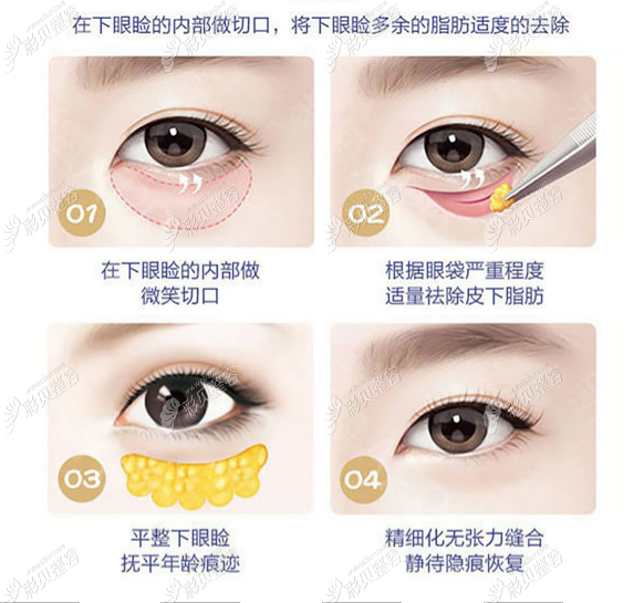 辽宁曙光外科整形医院眶隔脂肪释放