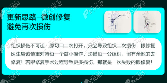 广州美莱整形双眼皮修复技术介绍 