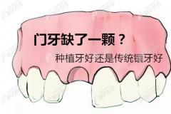 门牙缺失种牙好还是镶牙好?这有种植牙和镶牙的区别图解