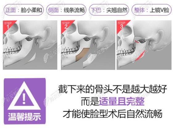 广东徐威强医生磨骨技术怎么样