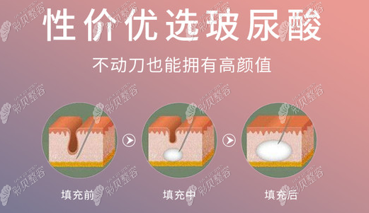玻尿酸丰卧蚕