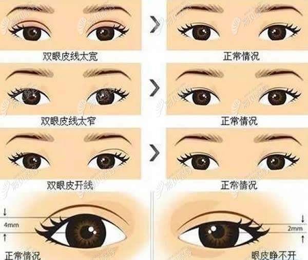 上海许炎龙医生做双眼皮修复如何?都说他做眼睛技术蛮好的