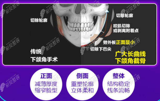 广州韩妃医院柳超磨骨怎么样