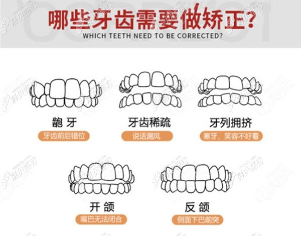 哪些牙齿需要矫正