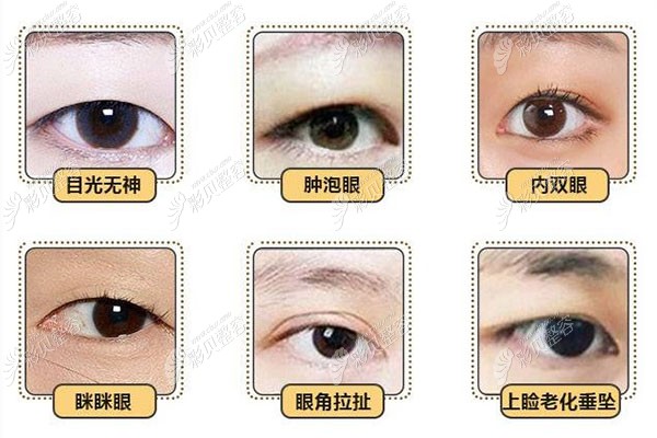 适合做双眼皮的眼