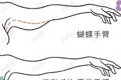 杭州时光吸脂靠谱的医生范眉清做抽脂减肥的价格建议保存