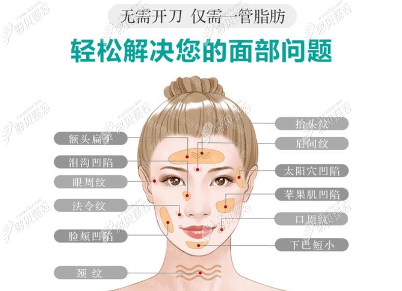 南京华美面部除皱医院做全脸脂肪填充技术好 南京华美面部除皱医院做全脸脂肪填充技术好