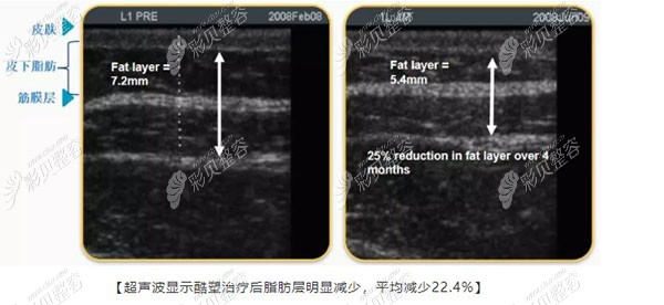 露宿冷冻减脂的效率
