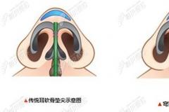 鼻部穹隆再造这种鼻部手术方式做出来的鼻子真的自然吗