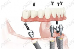 从allon4和allon6种植牙技术的区别来看all-on-4的弊端和耐久性